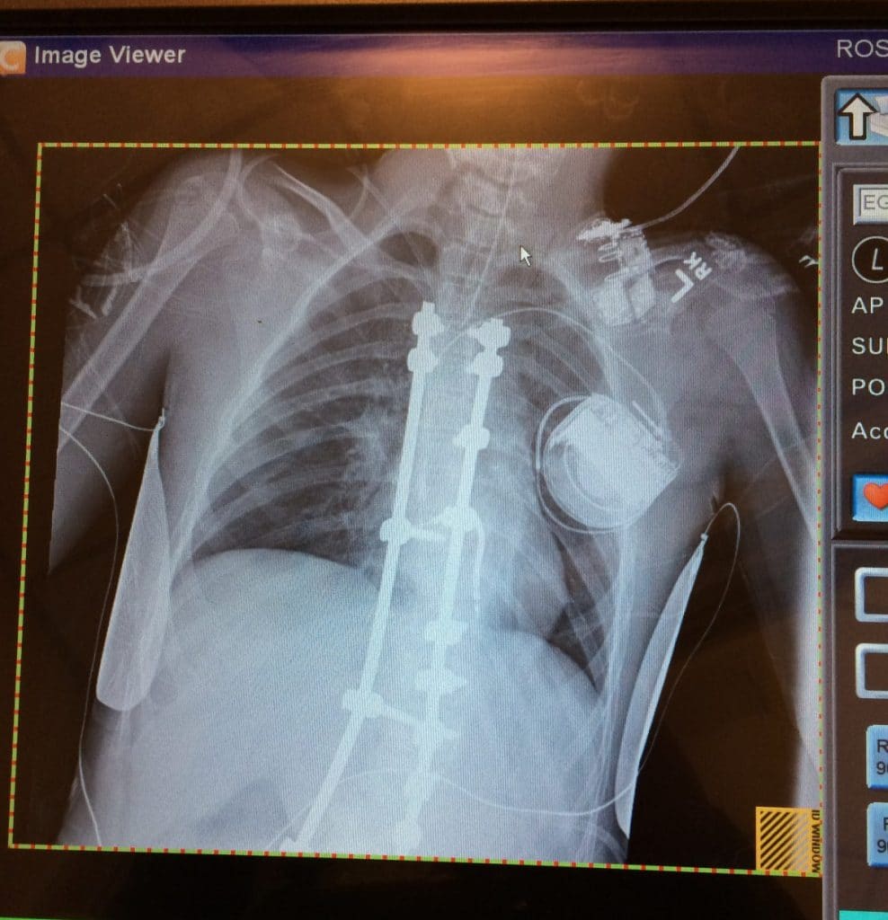 xray-spine-post-scoliosis-surgery